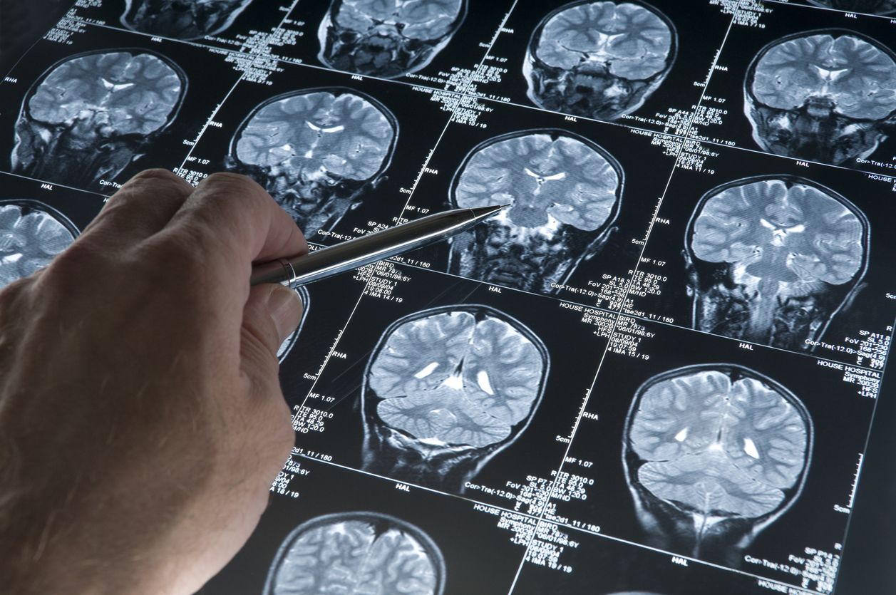 Image showing brain scans. For representational purposes. Credit: iStock Photo