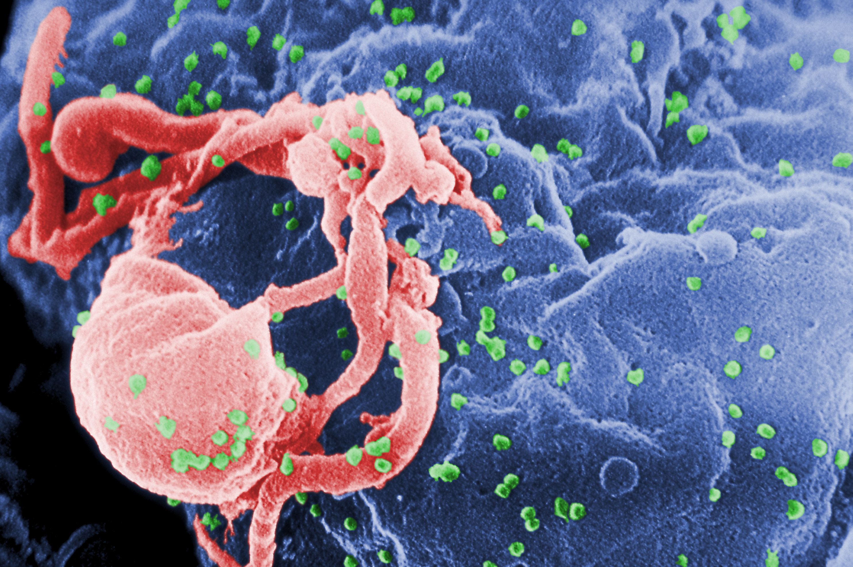 This scanning electron microscopic (SEM) image shows the presence of numerous human immunodeficiency virus-1 (HIV-1) virions (spherical in appearance) budding from a cultured human lymphocytes in this 1989 image obtained from Centers for Disease Control and Prevention (CDC) in Atlanta, Georgia, on March 5, 2019. Credit: Reuters Photo